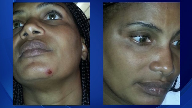 Pictures show a cut and bruise on Tiniko Thompson's face which she reportedly received in a scuffle with Miami police officer Carl Patrick.  (Source: Roderick Vereen) 