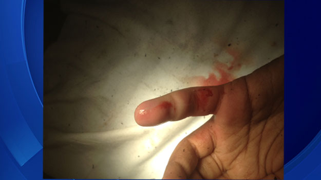 A child's finger after being removed from a metal pipe. (Photo source: FLFD)