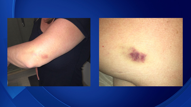Woman claims bruises came from fight with Carlos Alvarez (Source: CBS4 viewer) 