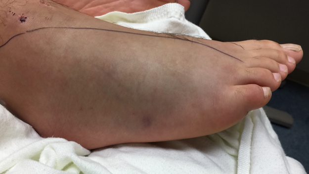 The swollen foot of a 17-year-old after a water moccasin bite in Broward County. (Source: Miami-Dade Fire Rescue Venom Unit)